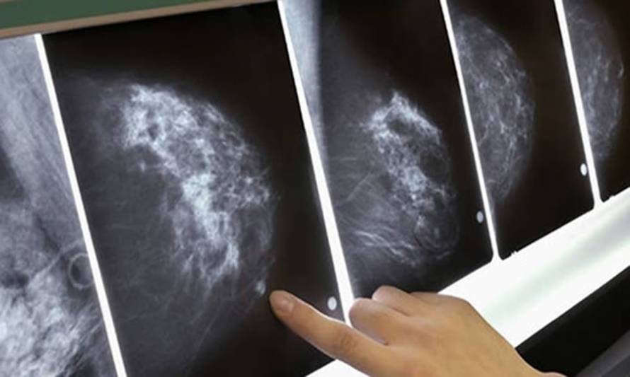 Inician campaña solidaria para mujer con cáncer de mama cuya mamografía fue informada dos años después